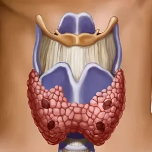 болезни щитовидной железы