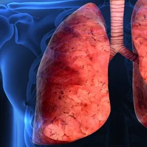 Туберкулез органов дыхания (1)