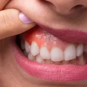 Предраковые заболевания слизистой оболочки рта